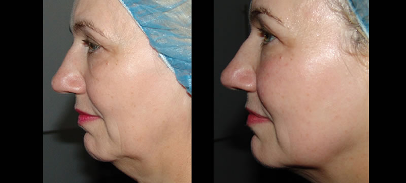 Pelleve Skin Tightening, Before & After Photos, LovelySkin Spa