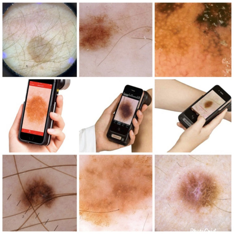 mole-mapping-stratford-dermatherapy-clinic